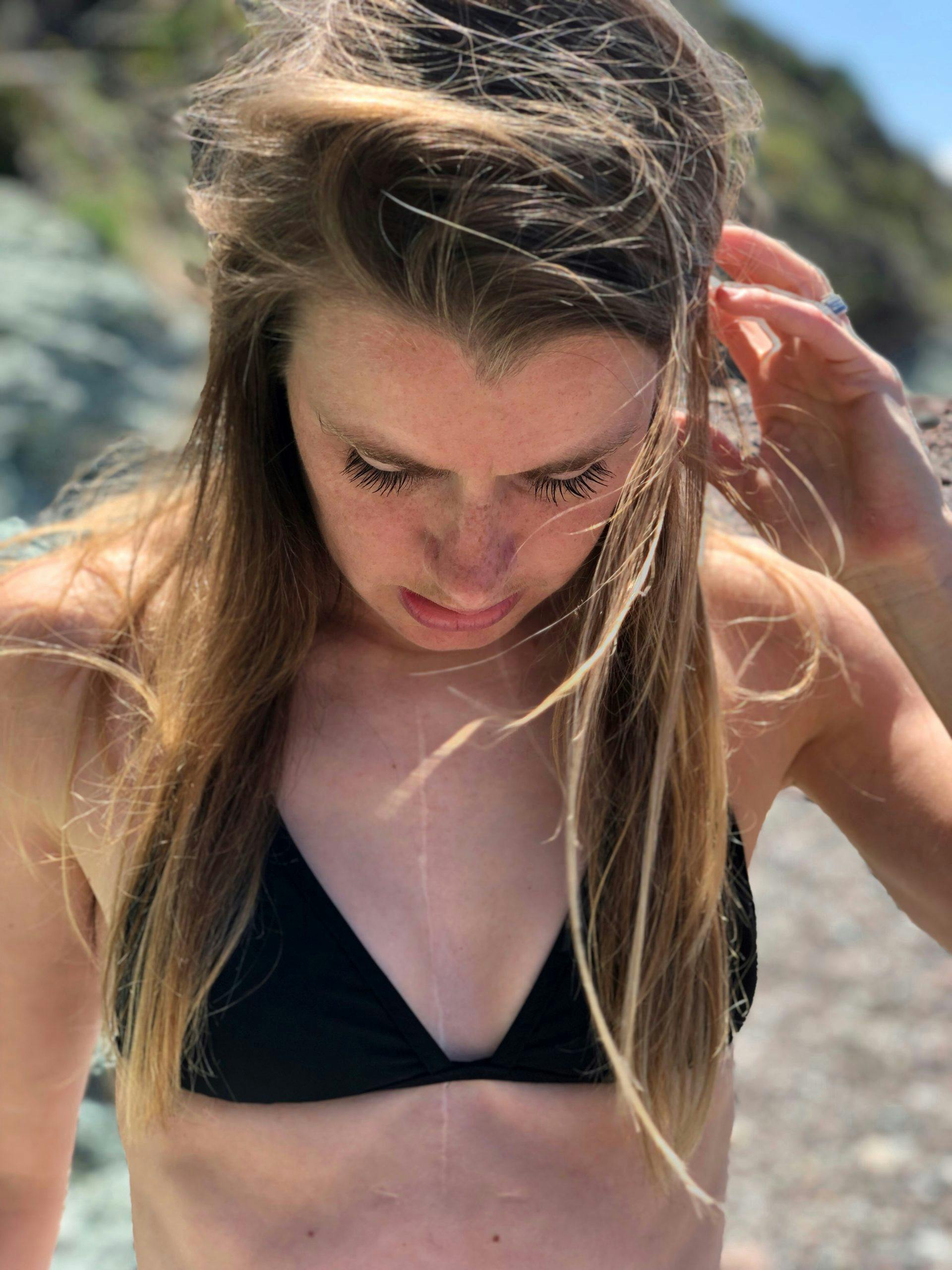 Vrouw met lang haar in zwarte bikini en litteken op borst