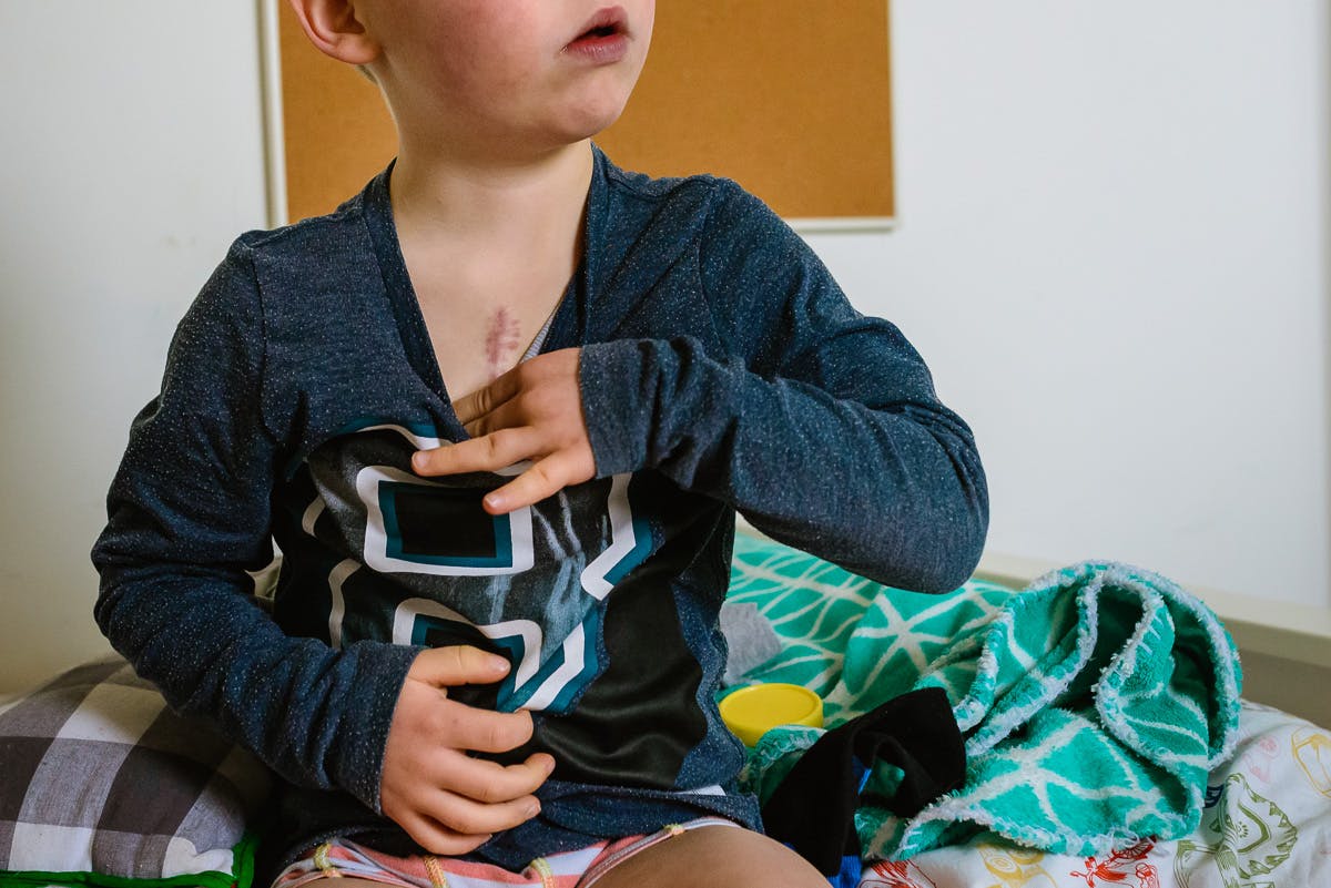 Jongen met litteken op de borst